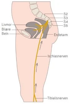 tibialisnerven diagram – Posebyen Helse